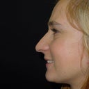 My horrible nose now