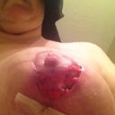 This pic looks good compared to when it looked its worse.  This is after correction surgery was done, and due to infection it basically blew the wound open and all stitches out.  Painful is an understatement.
