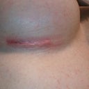 Right incision right after tapes being removed 11 days post op.