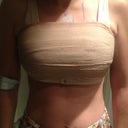 Post Op day 1 Front and swollen