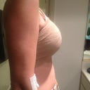 Post Op day 1