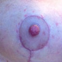 Tiny red spots around both areola's, appears that I had an allergic reaction to the Bacitracin ointment.  It took almost a week for the reaction to happen.  Stopped using the ointment and used anti itch cream and my essential oil blend mentioned in a previous update.