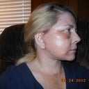 This is a side view I took today. I also had a growth removed from my chest. You can see my scars but they are so much better. Yes,  I would do it again!
