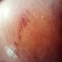 POD11 butt bruise from Lipo eventhough my flanks got Lipo'd...weird