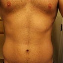 Before the procedure, front