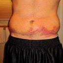 7 Days post-op, swelling and bruising to the max