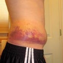 7 Days post op, side. Rainbow bruising!