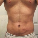 5 Weeks post-op, you can still see how loose the skin is.