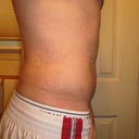 5 weeks, from the side you can see very significant results to the shape