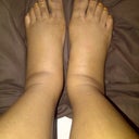 Swollen feet and ankles at the end of the day