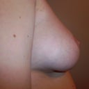 right 10 days post op