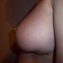 left 10 days post op