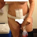 6 days post op