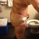 6 days post op