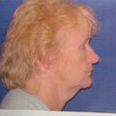 Before facelift. No jawline here.