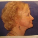 After.... need I say more?? Well defined jawline now.