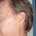 5 IPL treat over a year. This was at end of summer & I refused to avoid the sun all the time.