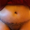 This picture was taken day 2 PO.  My doctor took out 7 lbs of fat and skin.