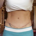 Six months but sure to have scar lowered again.  Will update after that is done.