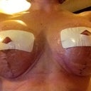2nd bandage change