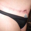 14 weeks post op