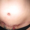 14 weeks post op