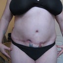 14 weeks post op
