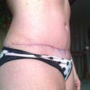 2 mo. PO. Gettin' real with the recovery - I still have stretch marks, most at/below the incision scar. Makes me look sort of "lumpy" but it's really the shiny stretch marks.