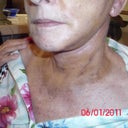 another view of turkey neck gone!!!