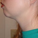 5 Weeks Post - Left