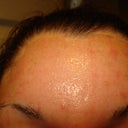 4 days post smartxide