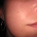 check photo.  scars are not as noticable on camera