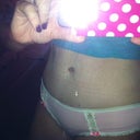 2 weeks post BB revision