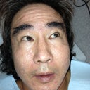 Acne Scarring-Ulthera, Fat Transfer, Mixto, PRP And Stem Cells -3 Sessions