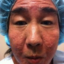 Acne Scarring-Ulthera, Fat Transfer, Mixto, PRP And Stem Cells -3 Sessions