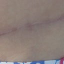 my scar as of 4 mo. PO. Line is starting to turn white