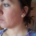 before treatme left side