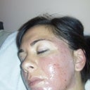 day of 1st treatment pinpoint bleeding