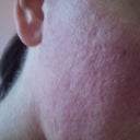 3 days after 1st treatment