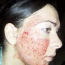 day of second treatment..pinpoint bleeding 80% more intense than first treatment