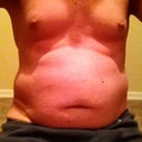 The "all muscle" Beer Belly night before surgery July 18, 2012.