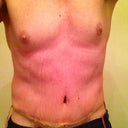 Post Op Day 2. Late in the evening.