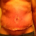 Post op Day 5, drains removed. Crusty appearance is actually fresh Neosporin cream. I didn't realize i had some swelling until I really looked at these pictures. oh well, part of the process.