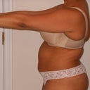 Pre Op Side View, morning of procedure (5/18)