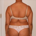 Pre Op Back View, morning of procedure (5/18)