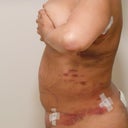 3 Days Post Op Side View (5/21)