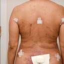 3 Days Post Op Back View