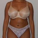 35 Days Post Op Front View (6/23)