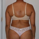 35 Days Post Op Back View (6/23)