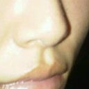 before perlane in nose pic (also 2 wks after blepharoplasties and scar revision by left eye)